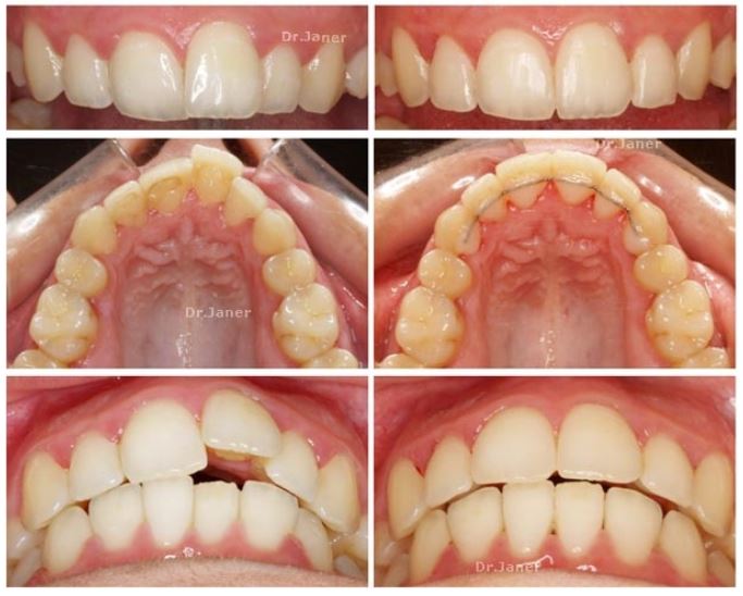 invisalign-barcelona-caso-1