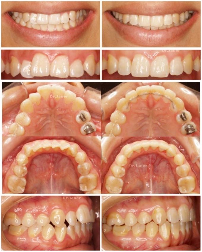 invisalign-barcelona-caso-2