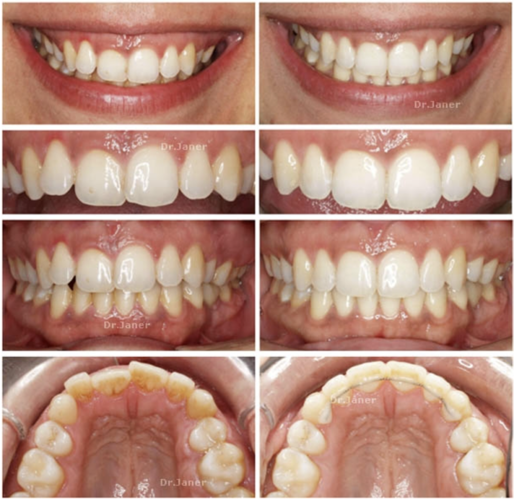 Invisalign Barcelona caso 4