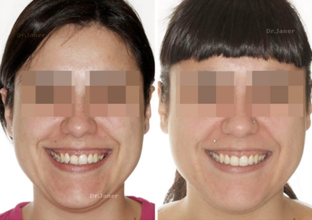 Invisalign Barcelona