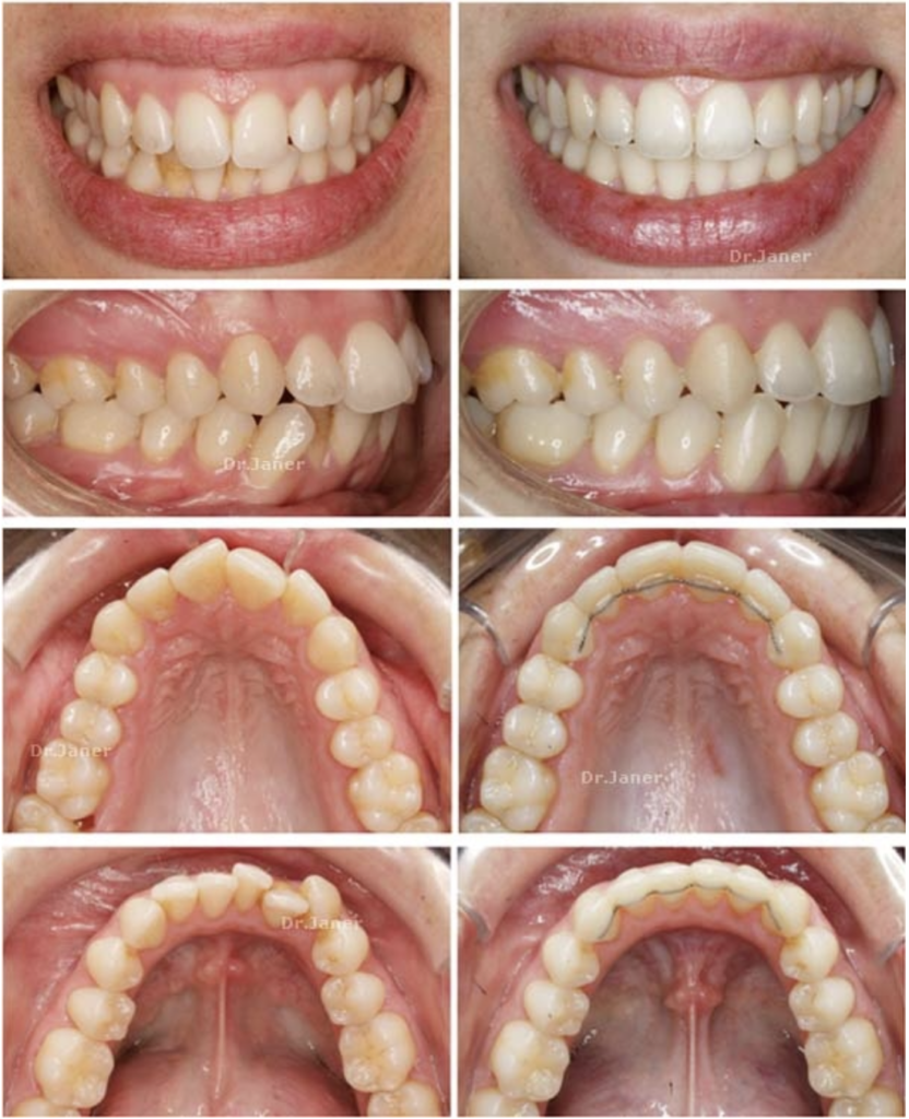 Invisalign Barcelona