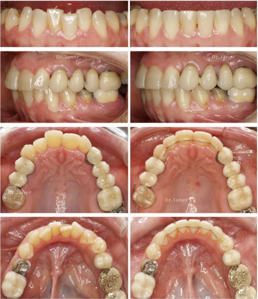 Invisalign Barcelona