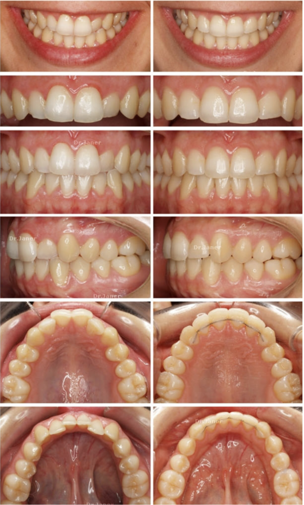 Invisalign Barcelona