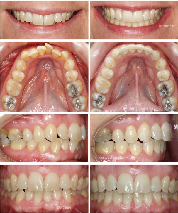 Invisalign Barcelona caso 3