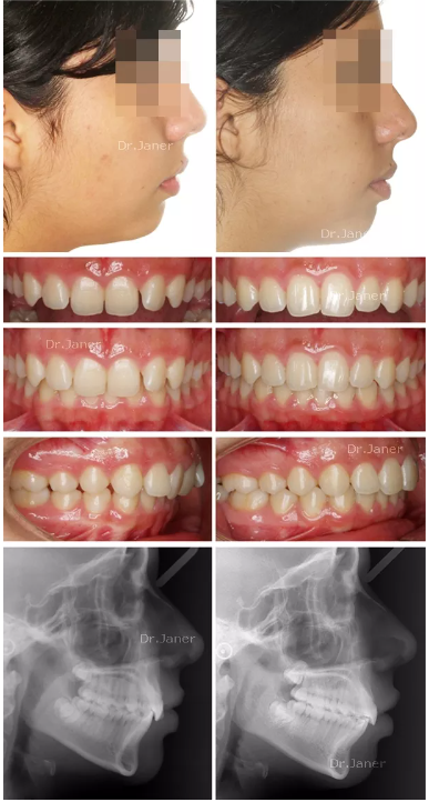 Invisalign Barcelona