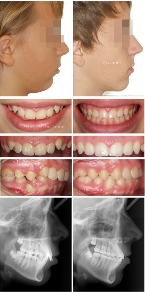 invisalign barcelona