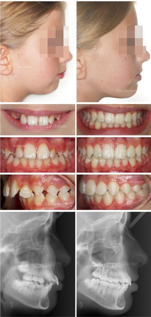 Invisalign Barcelona