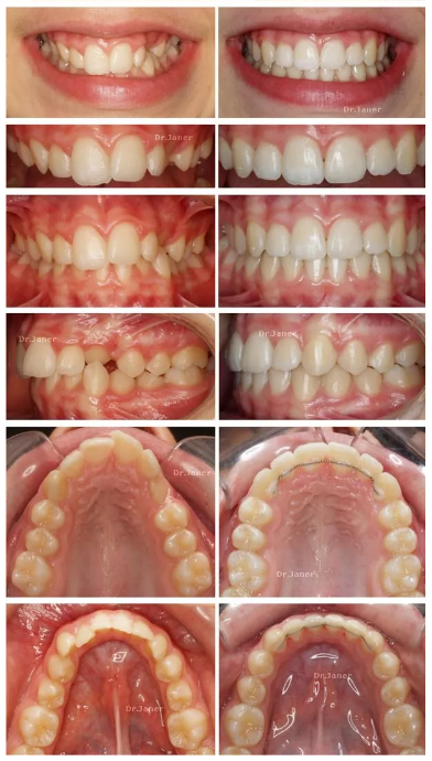 Invisalign Barcelona