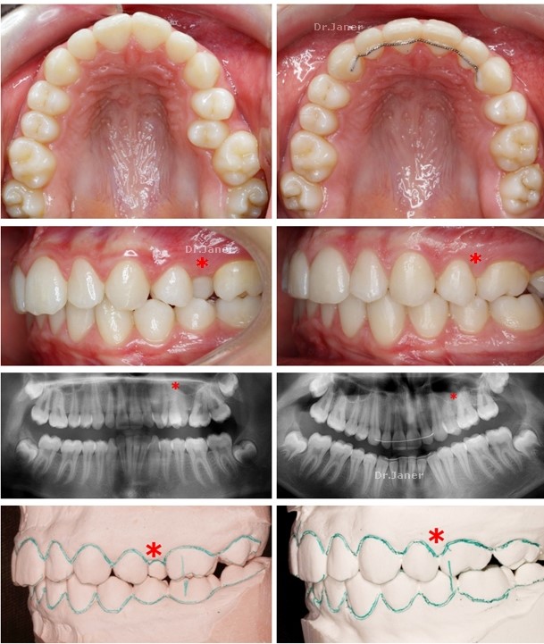 Invisalign Barcelona