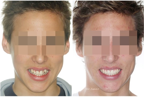 Invisalign Barcelona