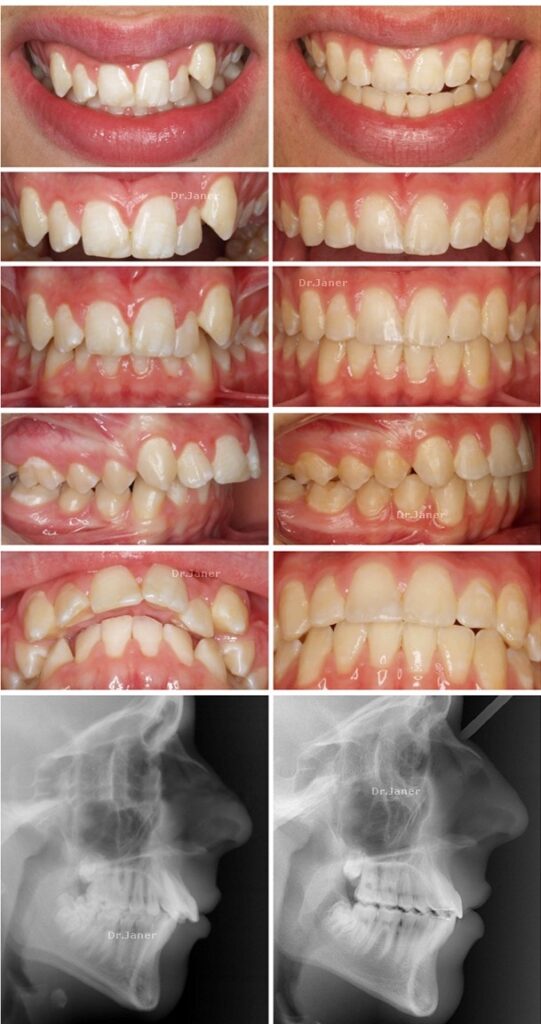 Invisalign Barcelona