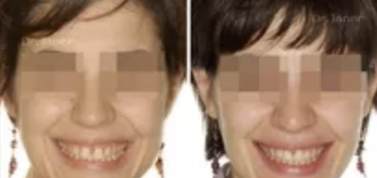 Invisalign Barcelona