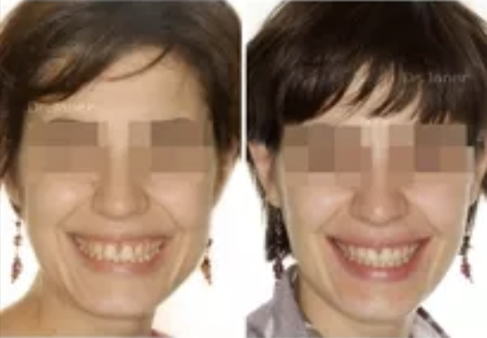 Invisalign Barcelona