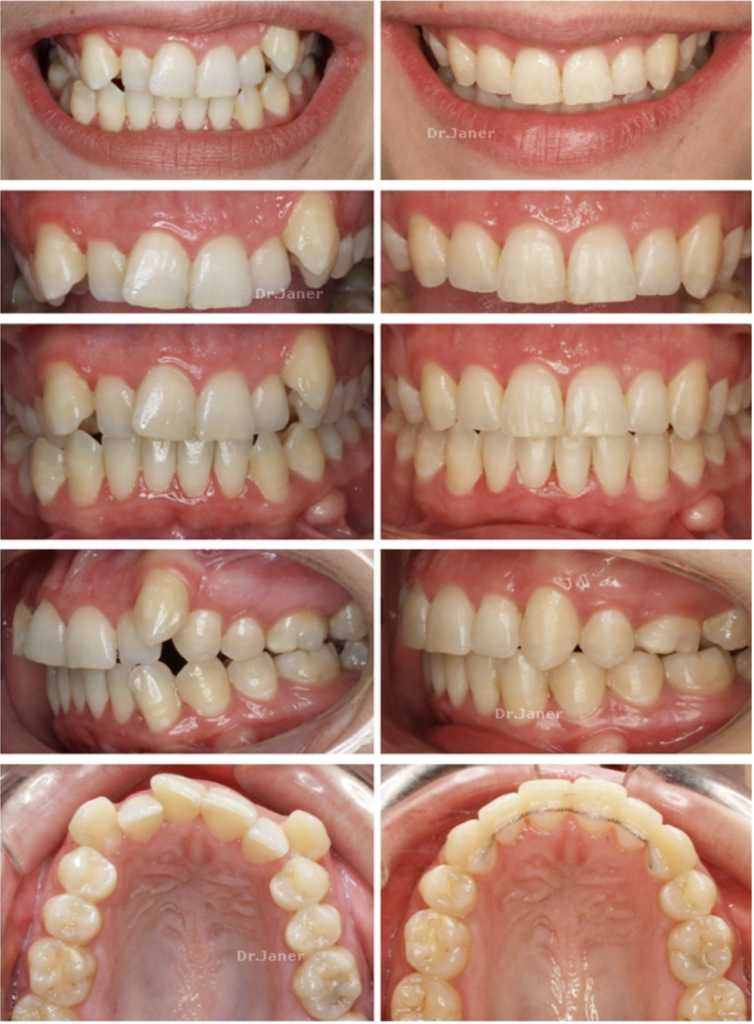 Invisalign Barcelona