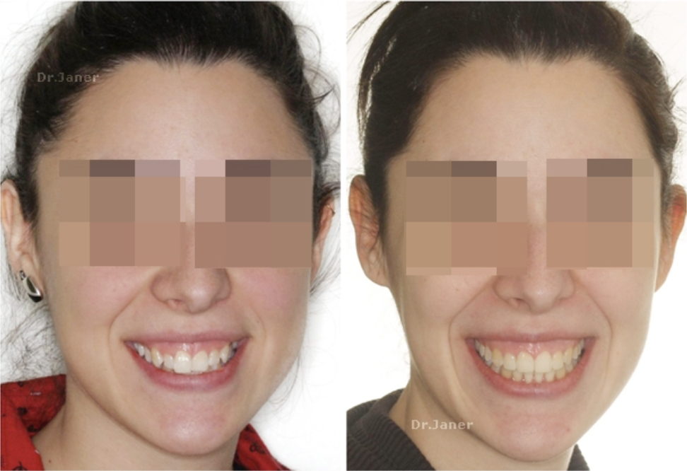 Invisalign Barcelona