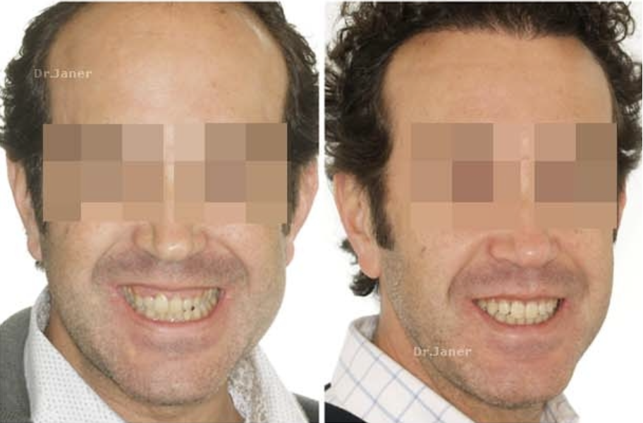 Invisalign Barcelona