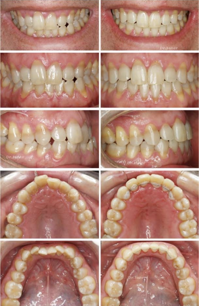 Invisalign Barcelona