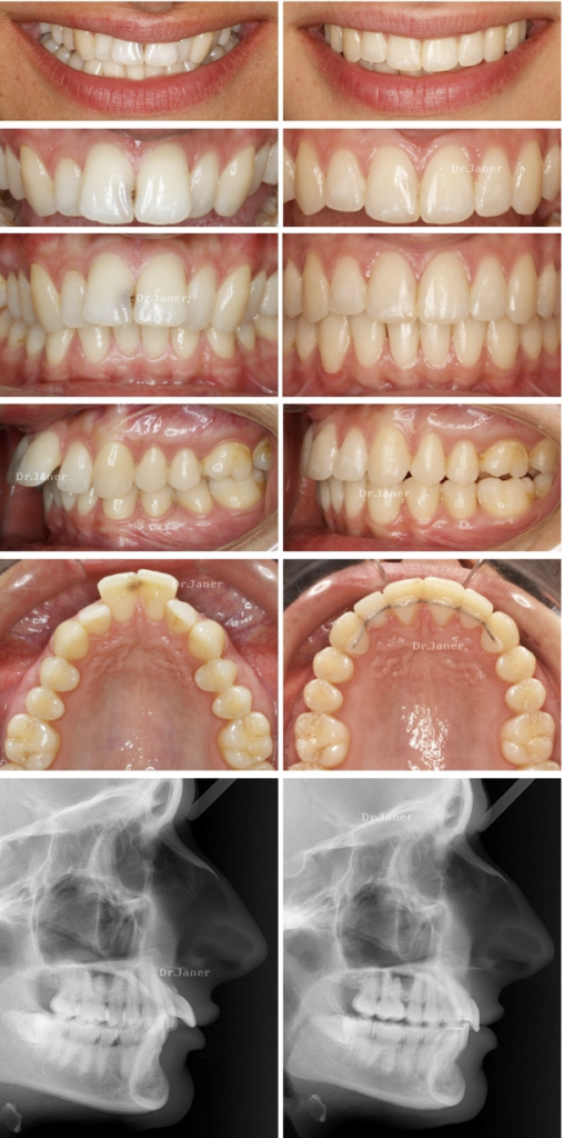 Invisalign Barcelona