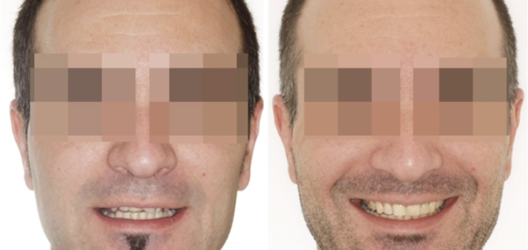 Invisalign Barcelona