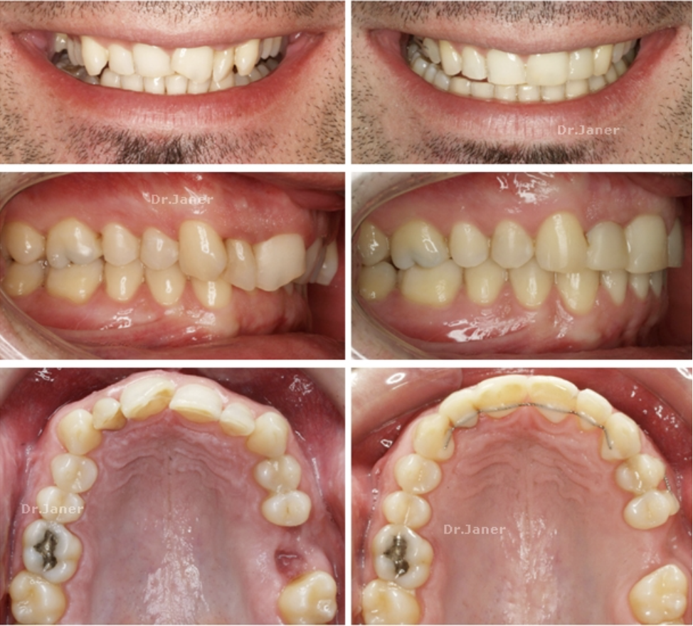 Invisalign Barcelona