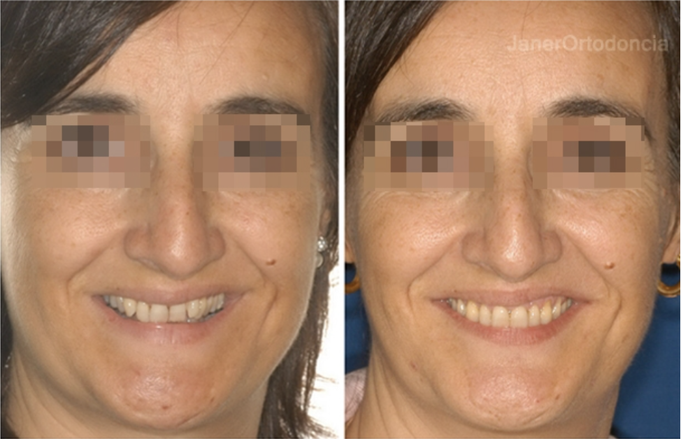 Invisalign Barcelona