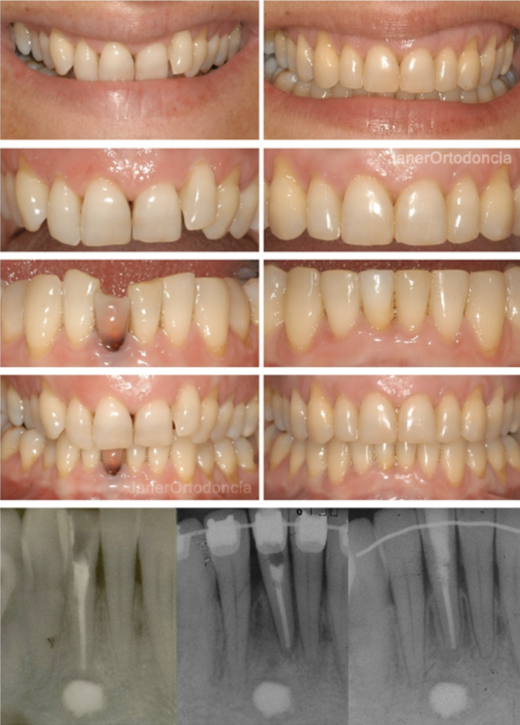 Invisalign Barcelona