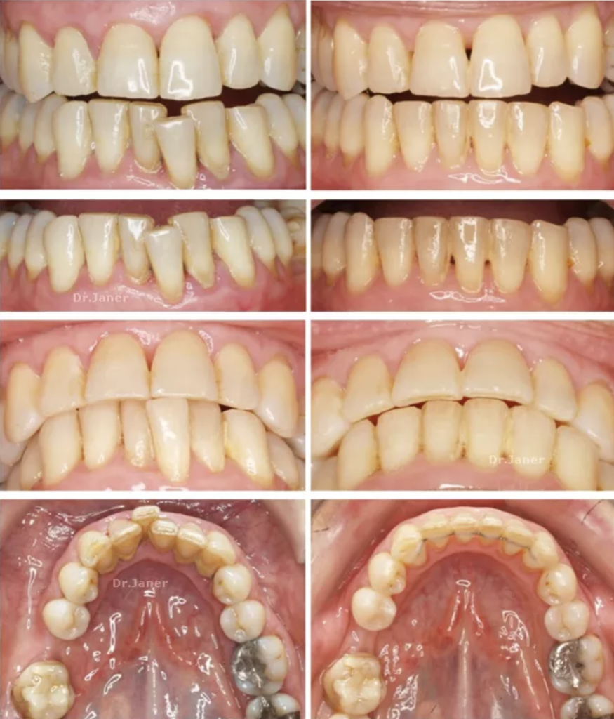 Invisalign Barcelona