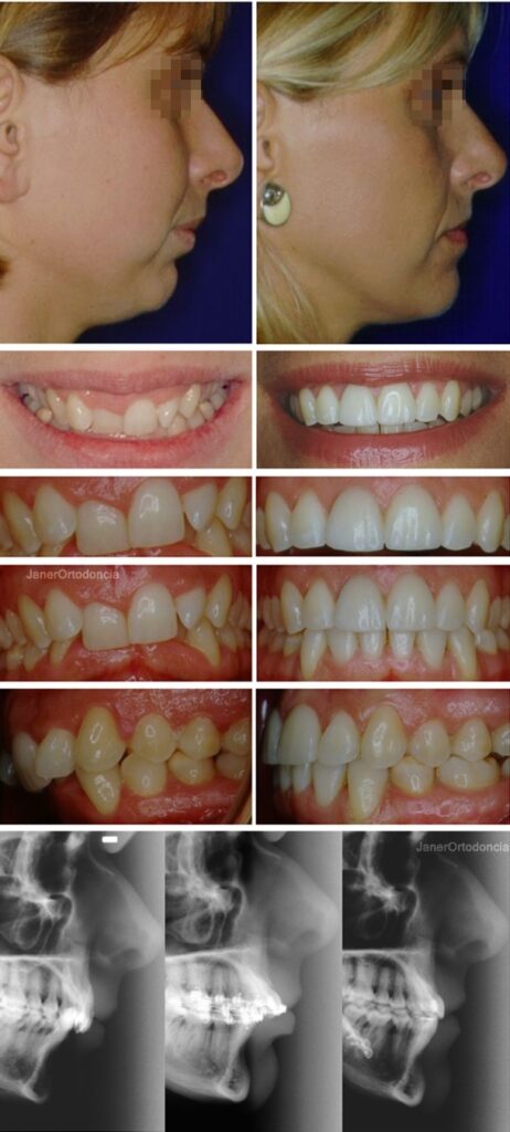 Invisalign Barcelona