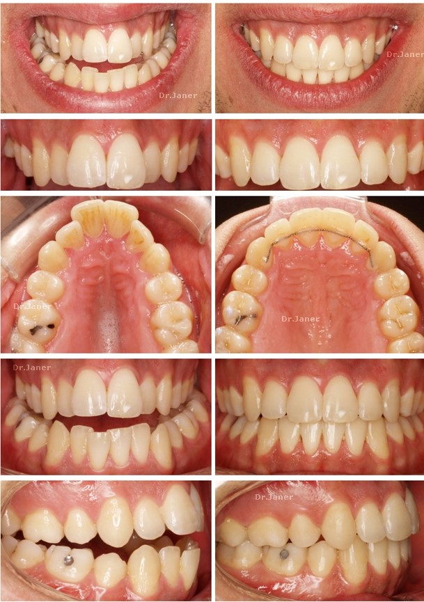 Invisalign Barcelona