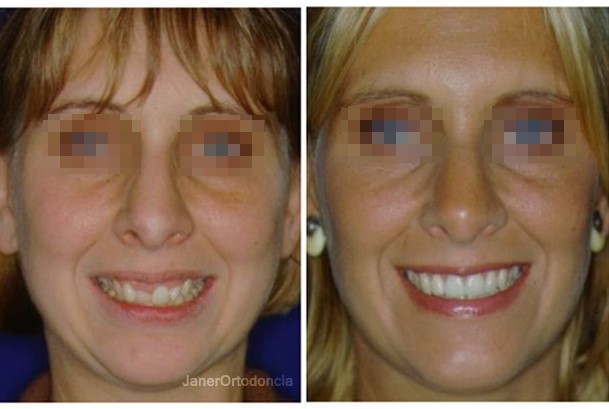 Invisalign Barcelona