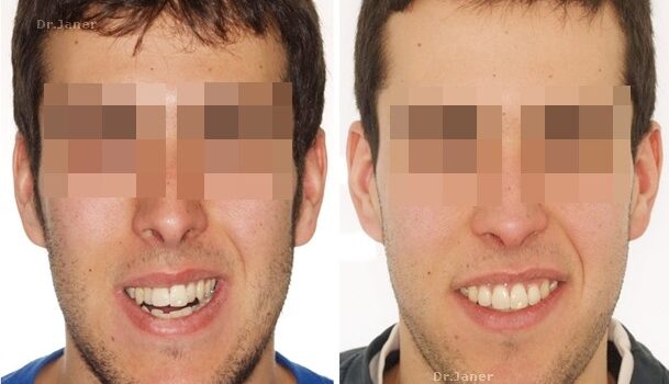 Invisalign Barcelona