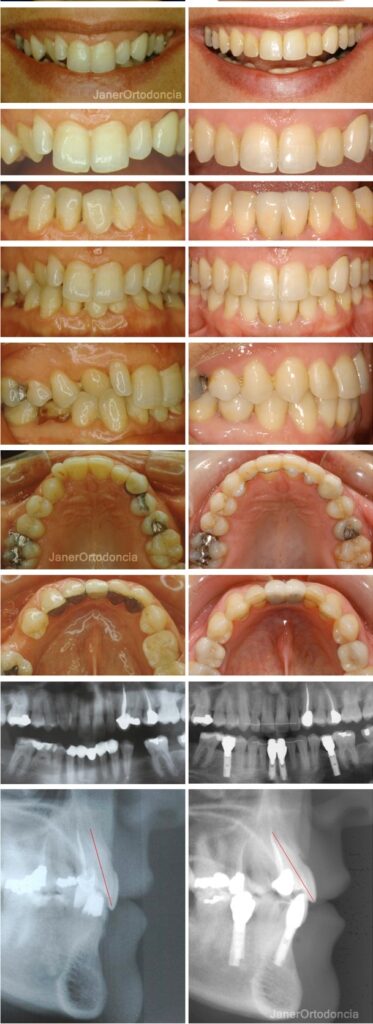 Invisalign Barcelona