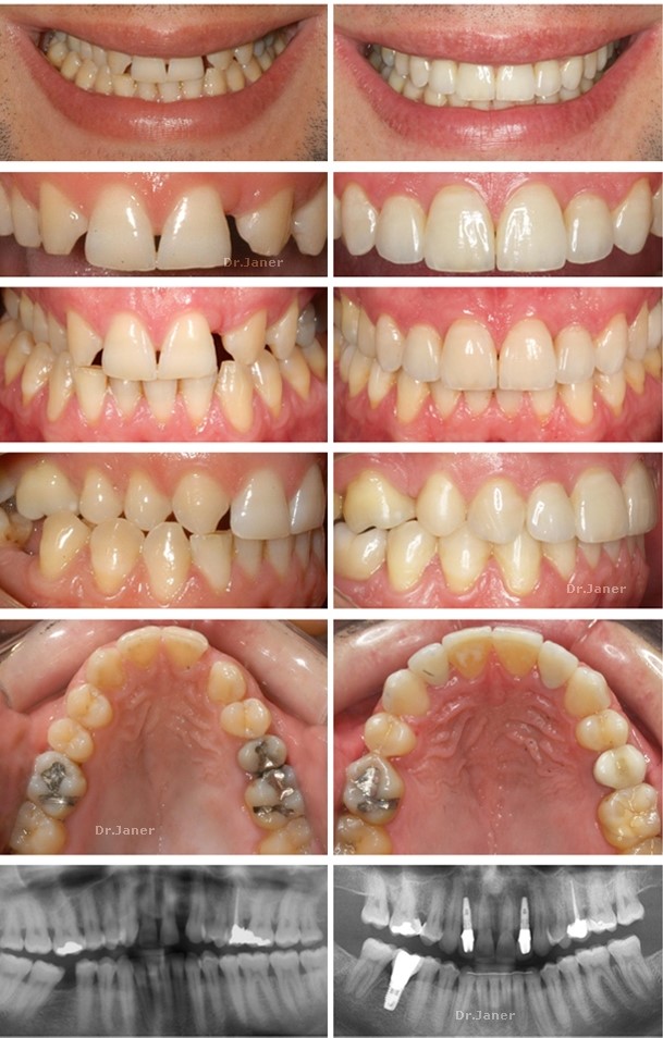 Invisalign Barcelona