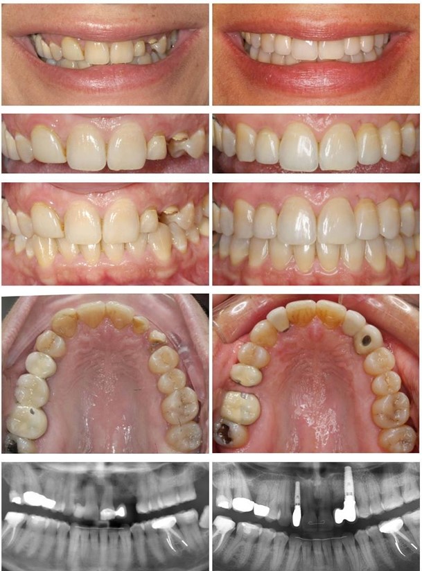 Invisalign Barcelona