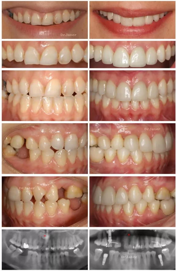 Invisalign Barcelona