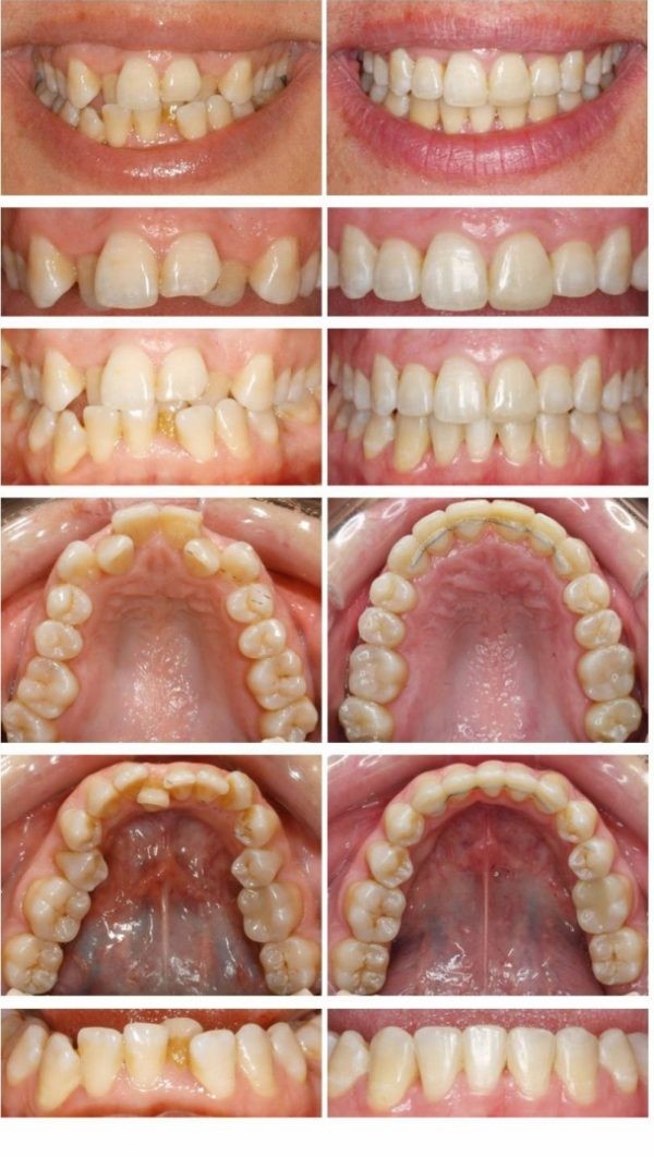 Invisalign Barcelona Paciente Simple - Invisalign Barcelona