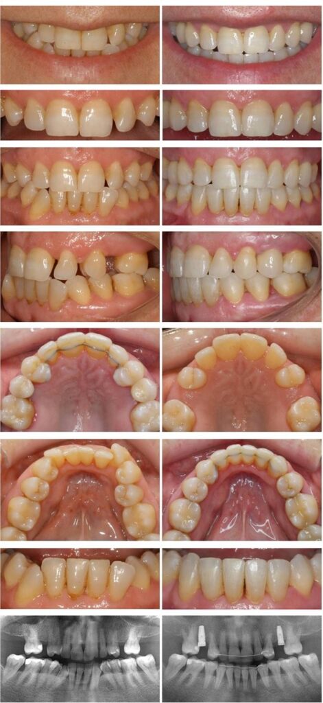 Invisalign Barcelona