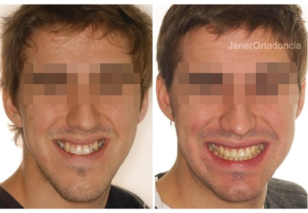 Invisalign Barcelona