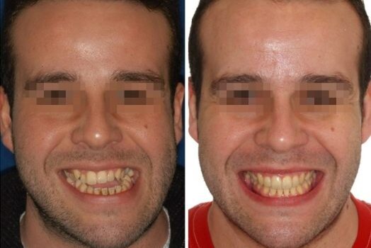 Invisalign Barcelona