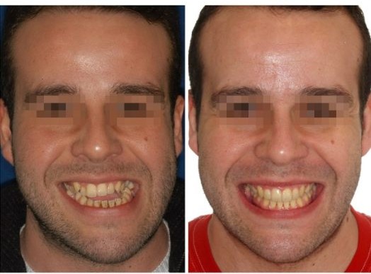 Invisalign Barcelona