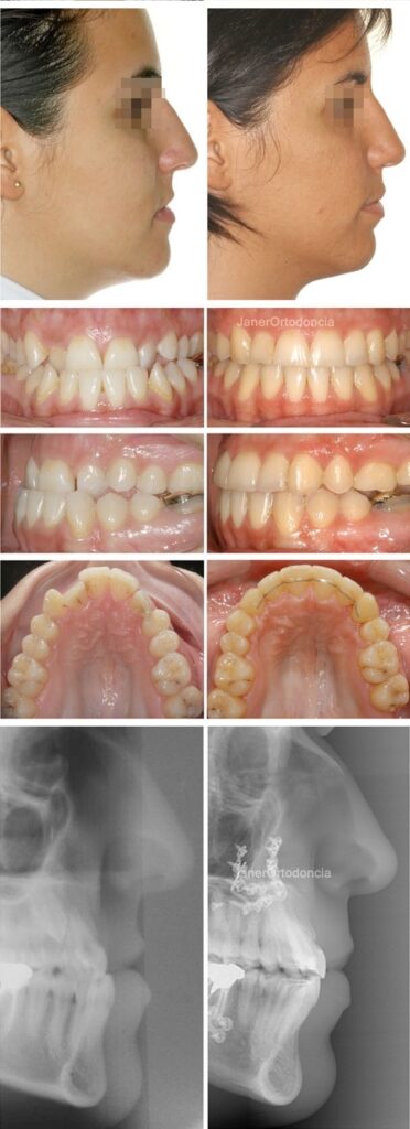 Invisalign Barcelona