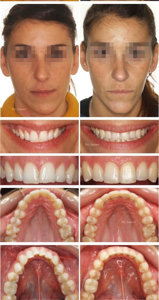 Invisalign Barcelona