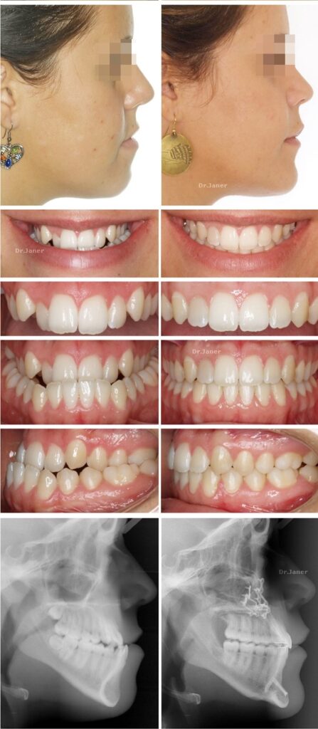 Invisalign Barcelona