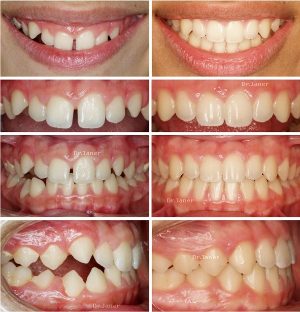 Invisalign Barcelona