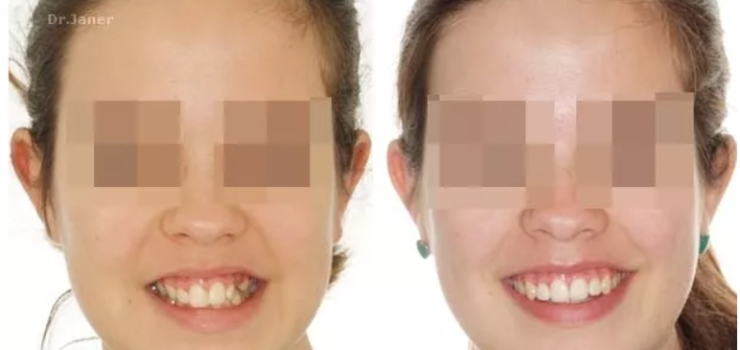 Invisalign Barcelona